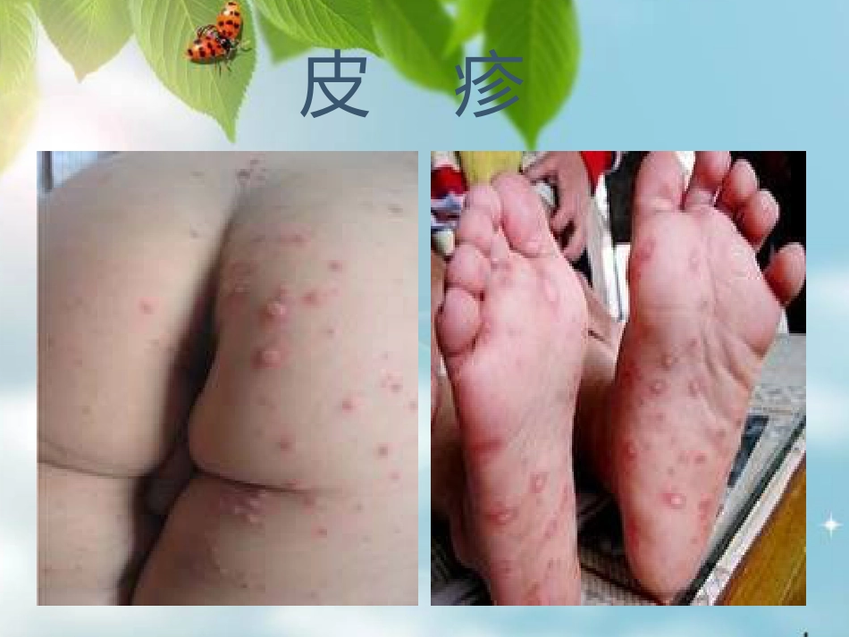 让你的孩子远离手足口病 (2)_第13页
