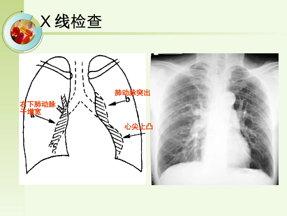 呼吸内科-肺源性心脏病病人的护理_第15页