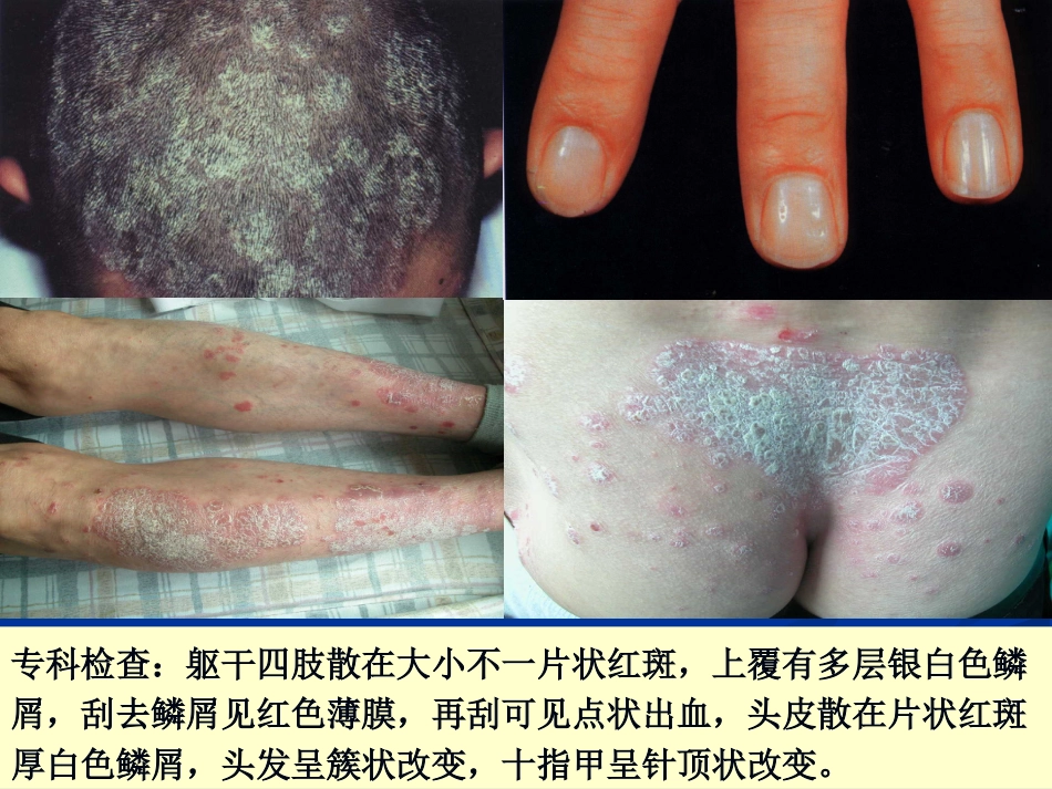 皮肤科-银屑病（牛皮癣）讲座_第3页