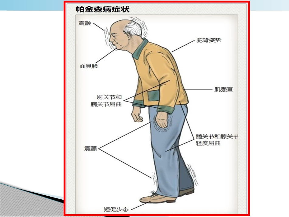 不怕帕金森病_第8页