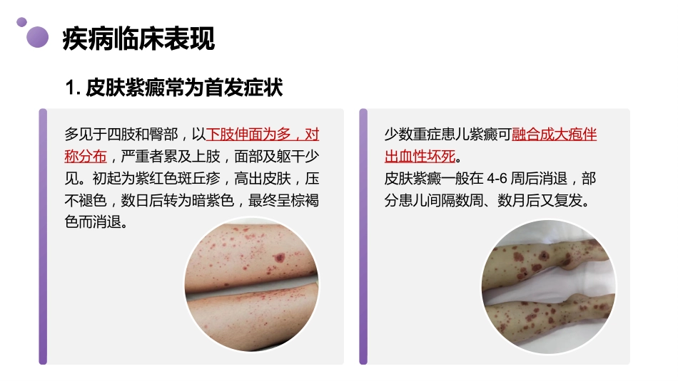 过敏性紫癜患儿的护理_第9页