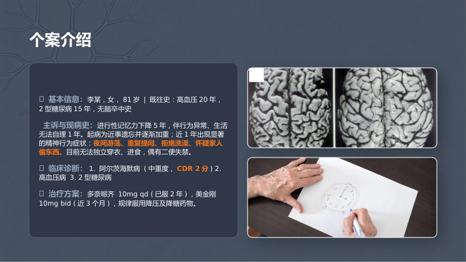 阿尔茨海默病个案护理PPT_第3页
