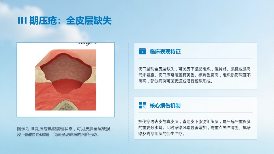 压疮的预防及护理_第8页