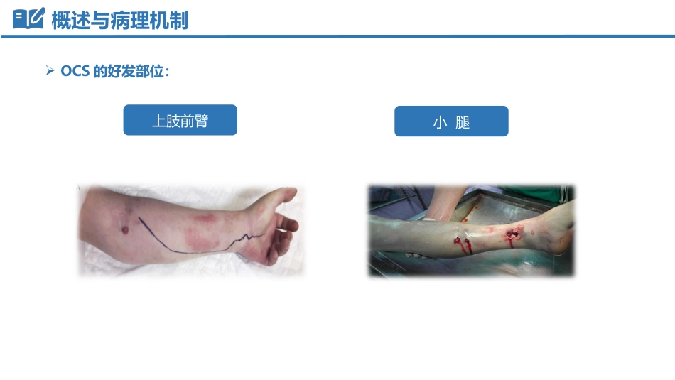 骨筋膜室综合征_第9页
