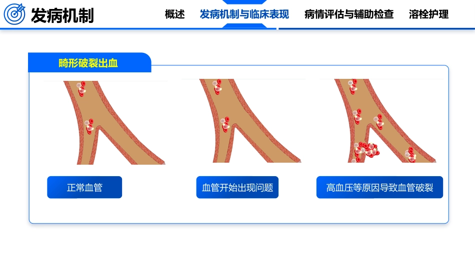 脑卒中的护理_第10页