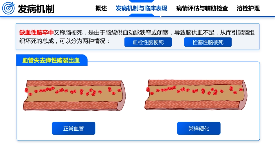 脑卒中的护理_第11页