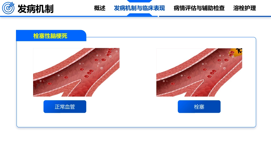 脑卒中的护理_第12页
