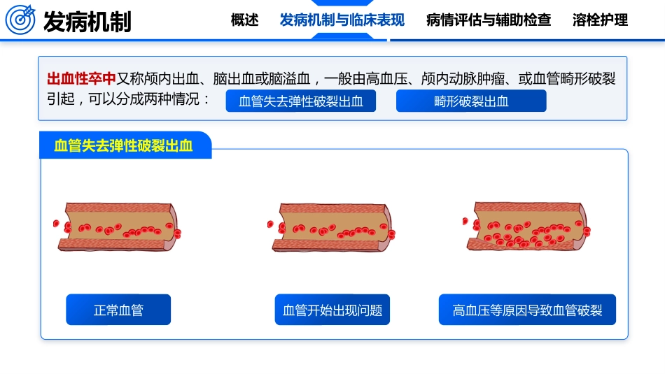 脑卒中的护理_第9页