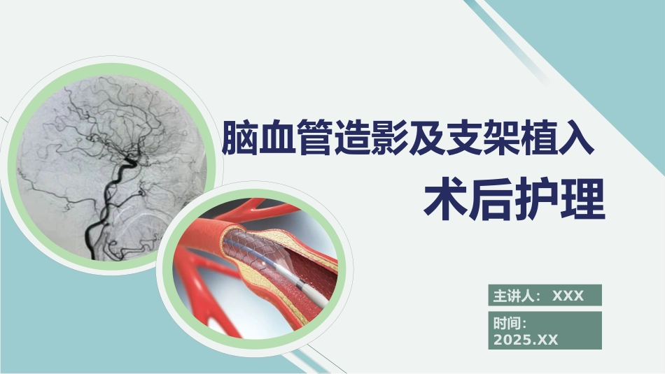 脑血管造影及支架植入术后护理_第1页