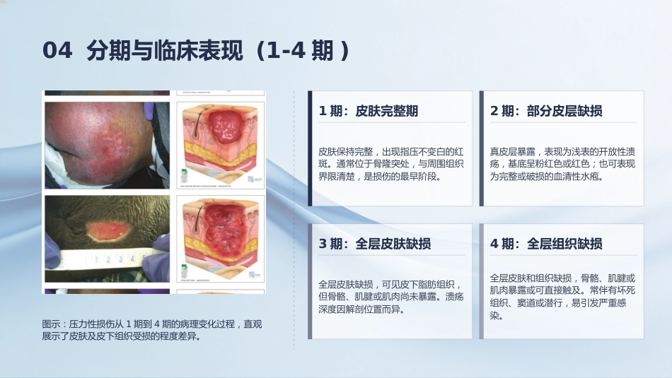 压力性损伤的预防及护理_第13页