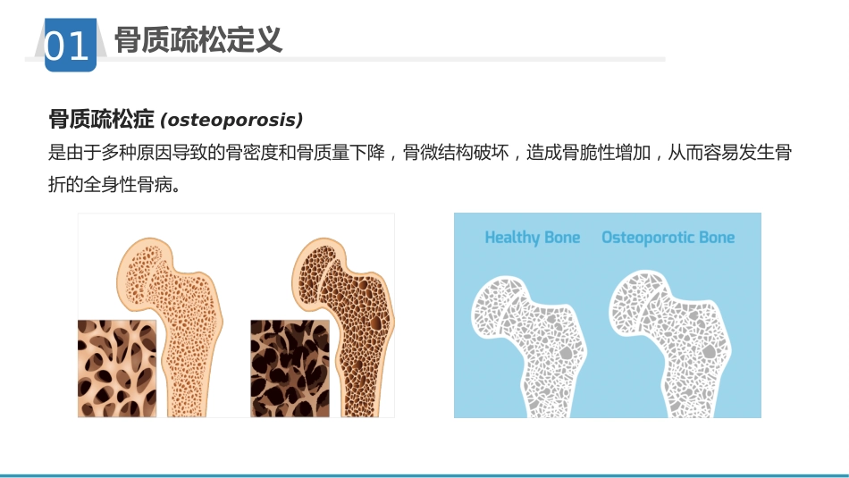 骨质疏松护理业务学习_第4页