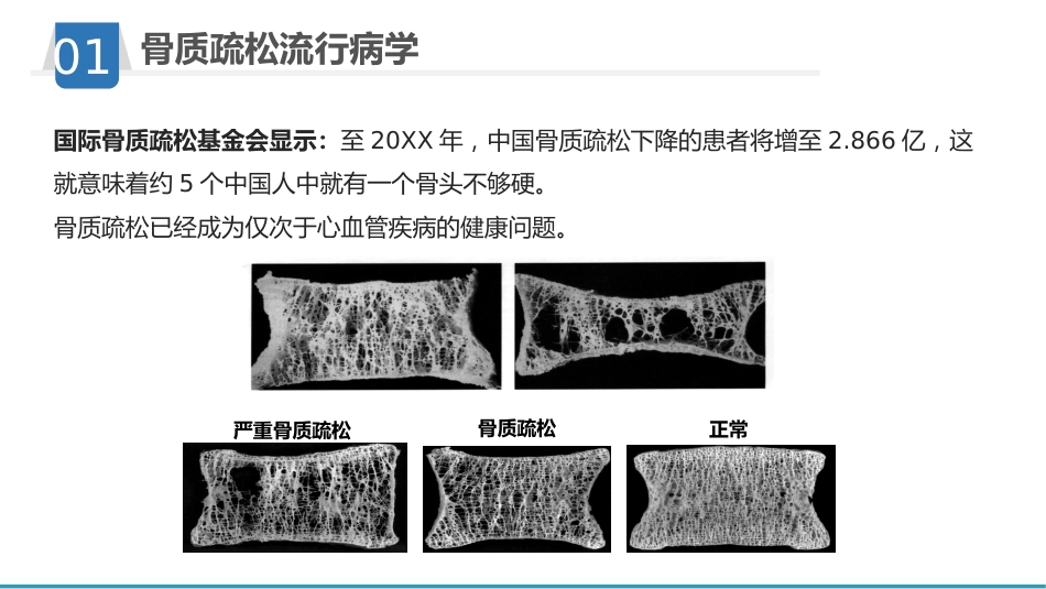 骨质疏松护理业务学习_第5页