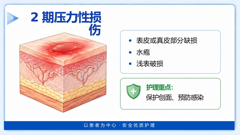 （压疮）压力性损伤的预防及护理_第10页