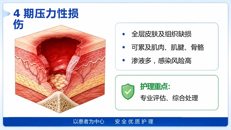 （压疮）压力性损伤的预防及护理_第12页