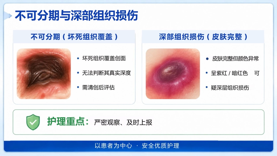 （压疮）压力性损伤的预防及护理_第13页