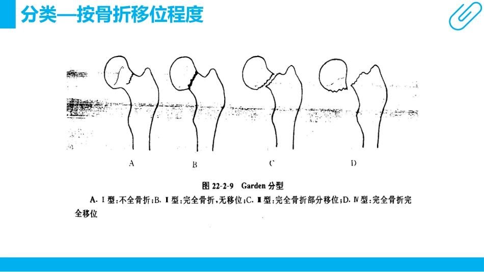 骨科护理查房ppt_第15页