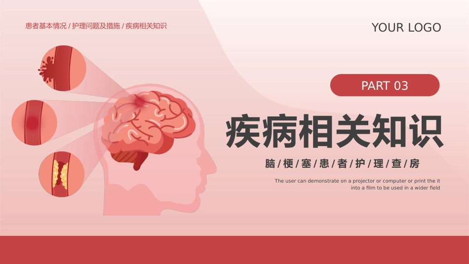 脑梗塞护理查房_第15页