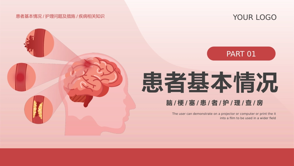 脑梗塞护理查房_第3页