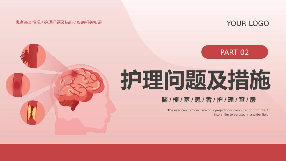 脑梗塞护理查房_第8页