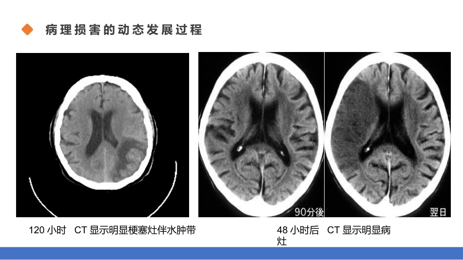 脑梗塞的分型分期治疗01_第10页