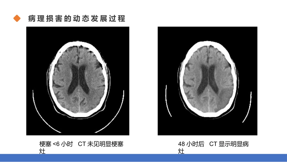 脑梗塞的分型分期治疗01_第9页