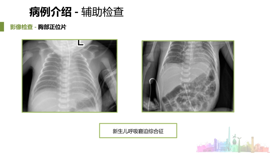 一例新生儿呼吸窘迫综合征患者的护理_第11页