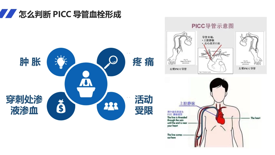 PICC导管血栓的护理_第6页