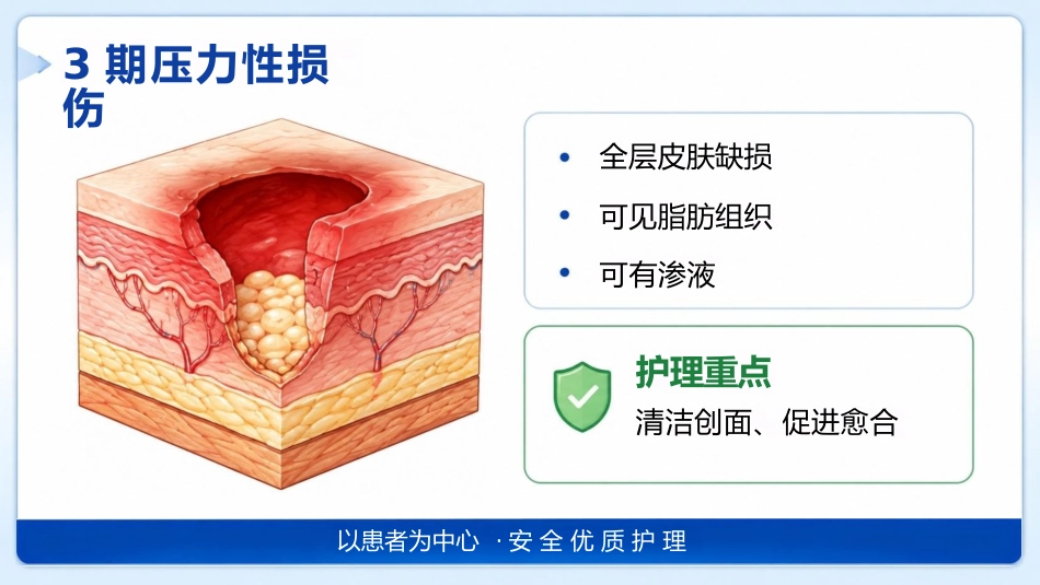 （压疮）压力性损伤的预防及护理_第11页