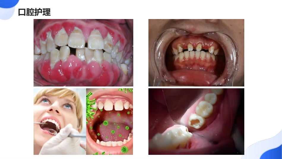 不同类型口腔黏膜炎护理_第5页