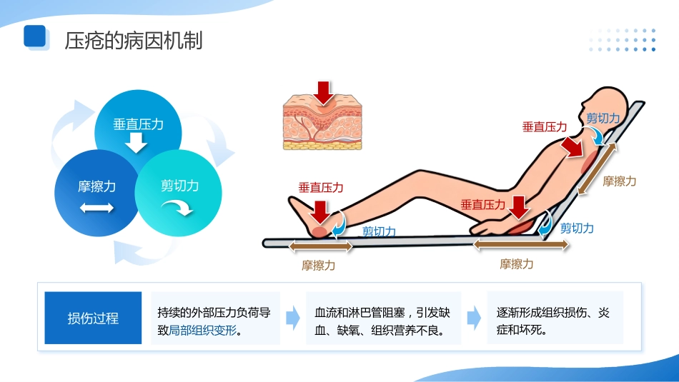 压疮的预防与护理讲座-1_第5页