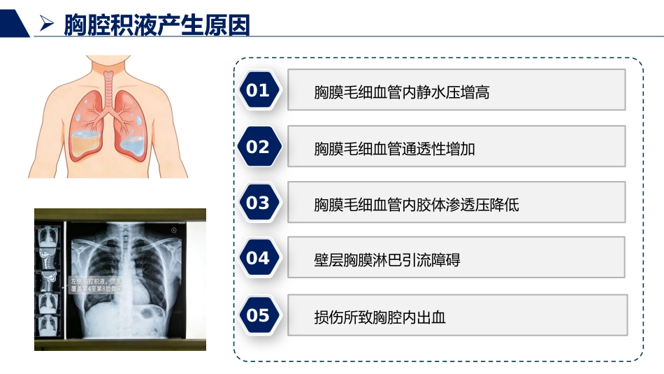 胸腔积液患者护理查房_第6页