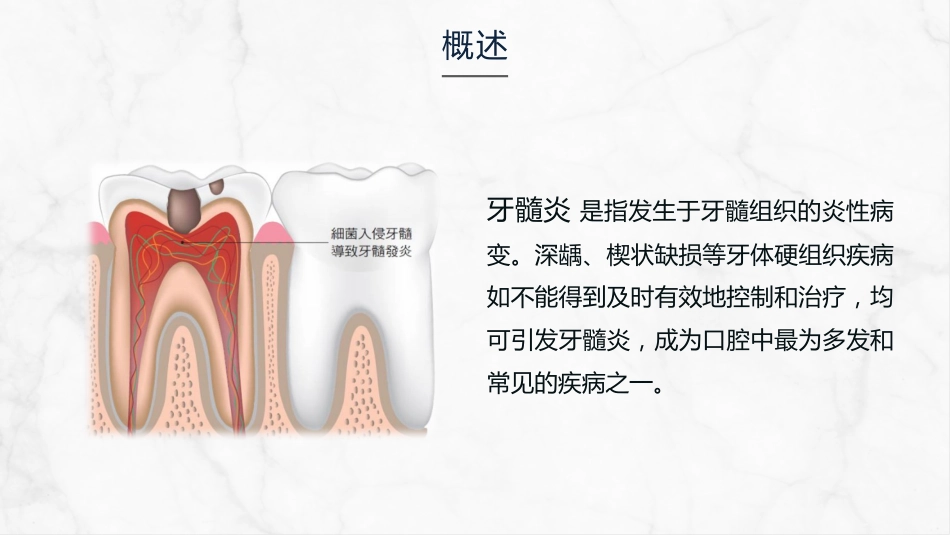 牙髓炎的护理查房知识课件_第4页