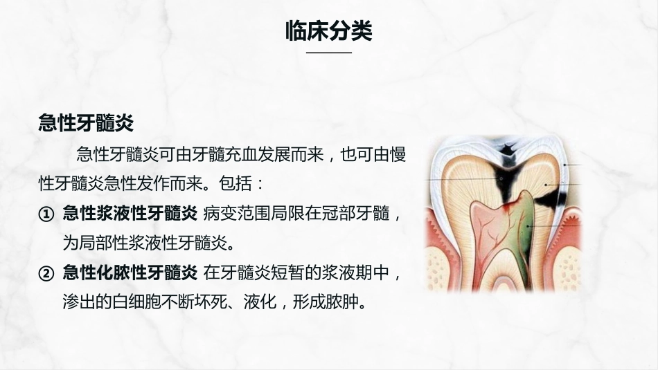 牙髓炎的护理查房知识课件_第5页