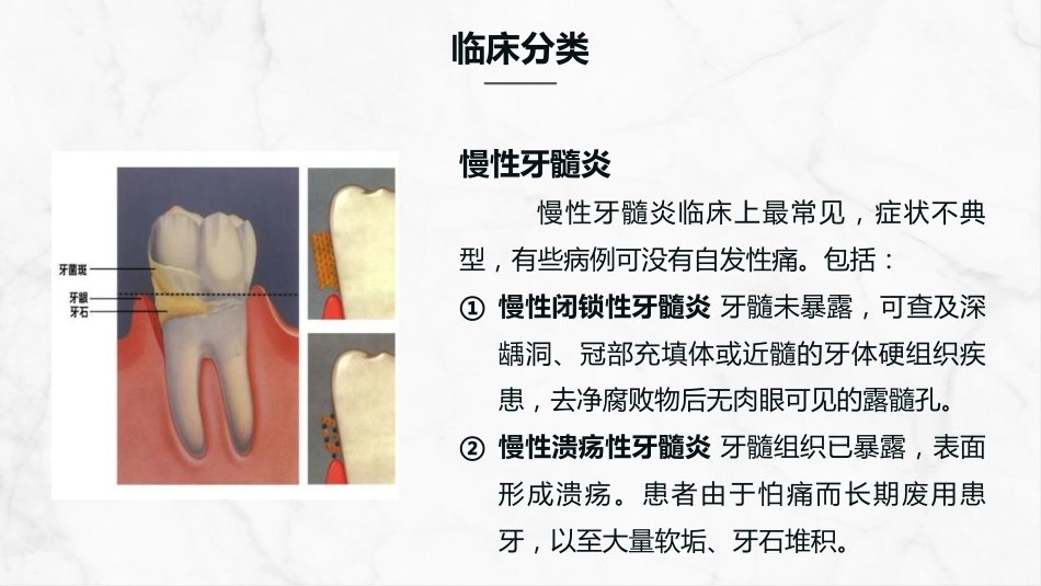 牙髓炎的护理查房知识课件_第6页