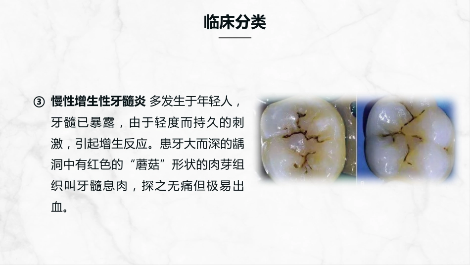 牙髓炎的护理查房知识课件_第7页
