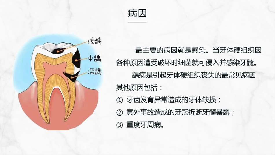 牙髓炎的护理查房知识课件_第8页