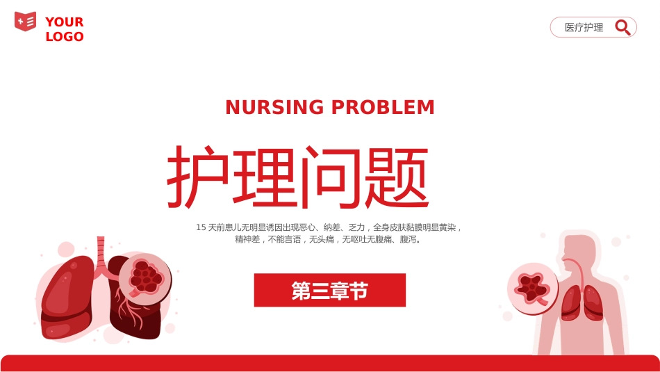 重症肝炎护理个案医疗健康护理培训PPT_第13页