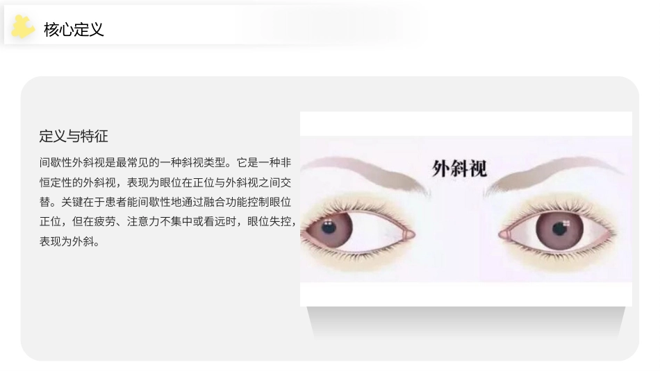 间歇性外斜视（IXT）护理查房带参考文献_第4页