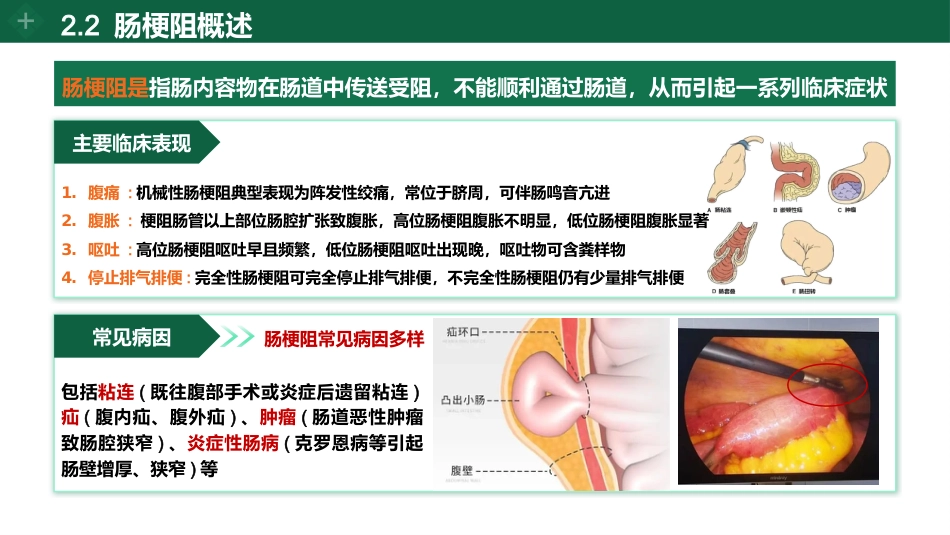 肠梗阻个案护理_第5页