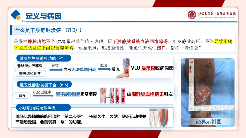 一例下肢静脉溃疡的护理pptx_第3页