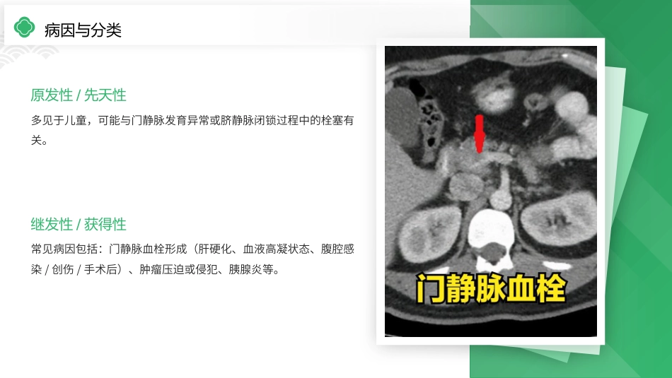 门静脉海绵样变性护理查房带参考文献_第5页