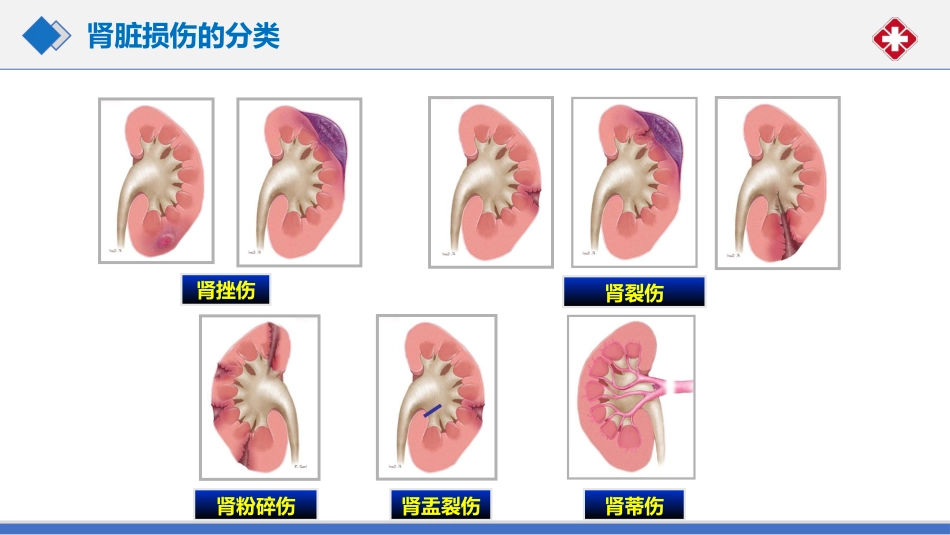 肾脏损伤的诊治(肾创伤)_第13页