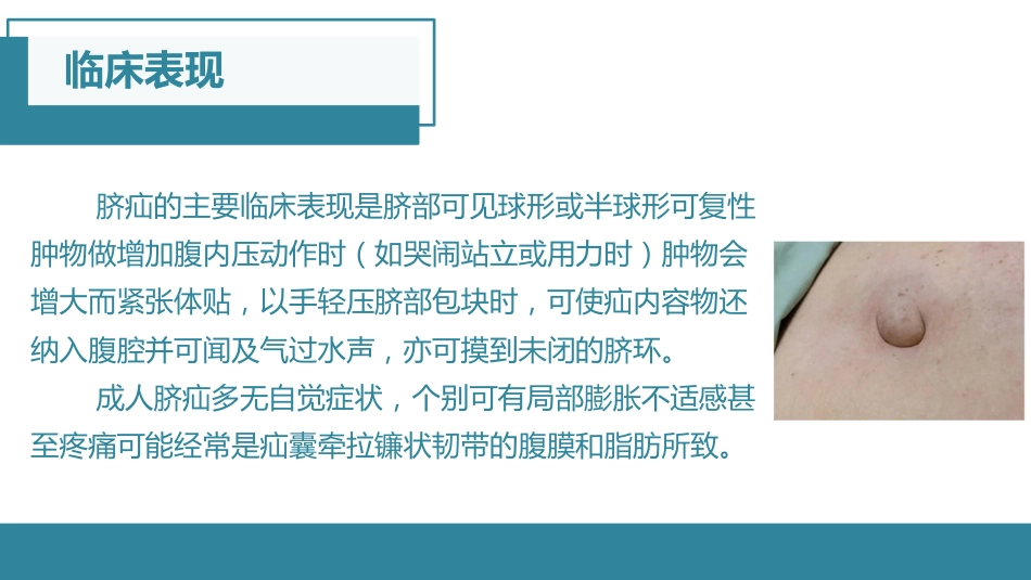 脐疝的护理查房_第4页