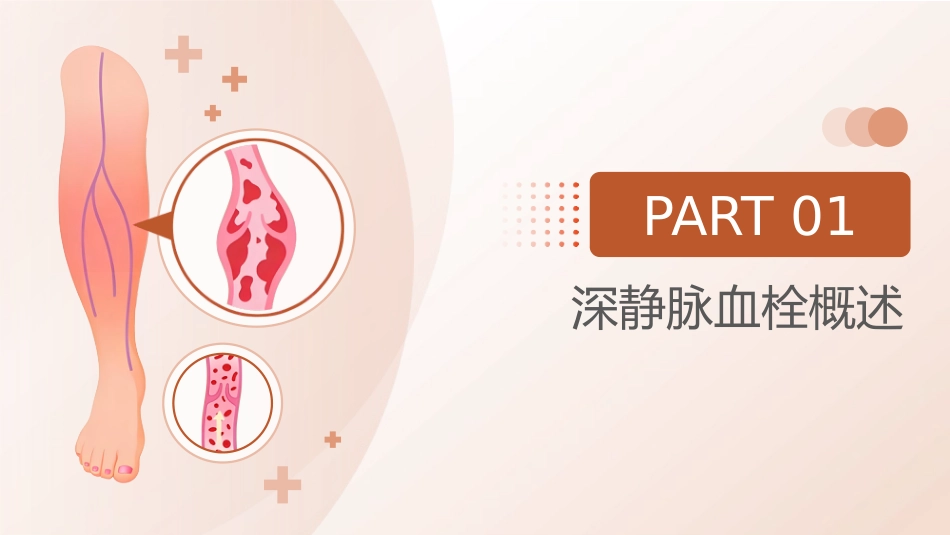 深静脉血栓预防管理讲座_第3页