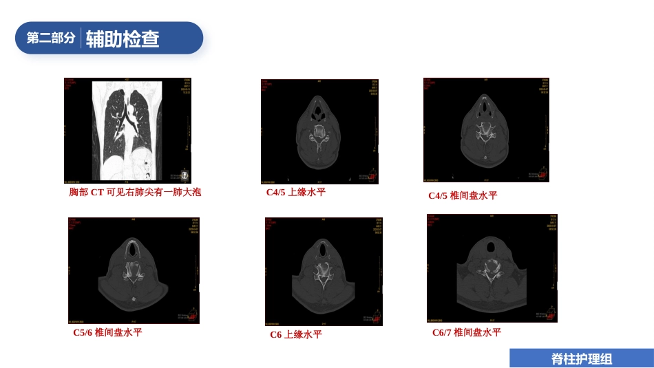 1例颈椎后路单开门减压手术的护理查房_第15页