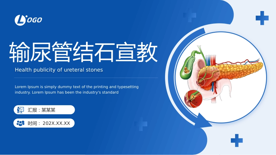 输尿管结石宣教_第1页