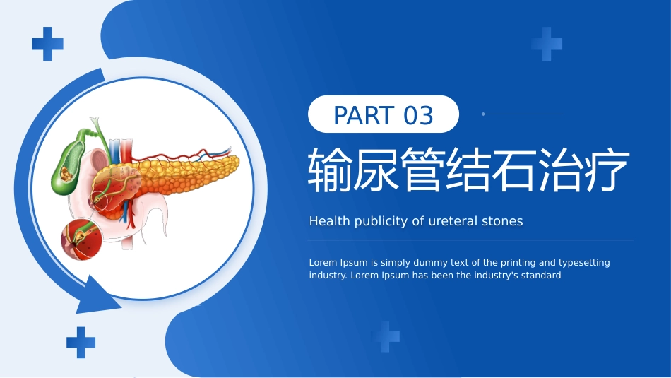 输尿管结石宣教_第13页