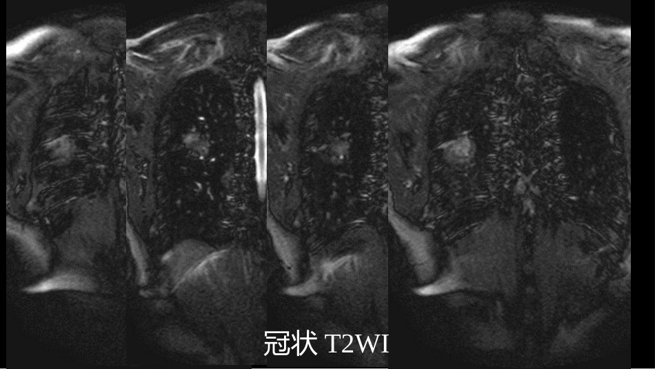 肺部肿块有效的影像检查选择_第12页