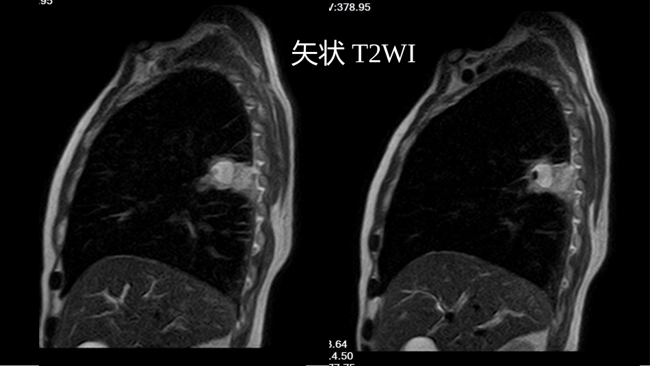 肺部肿块有效的影像检查选择_第15页