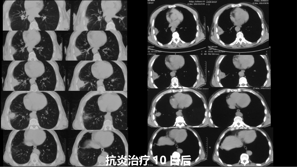 肺部肿块有效的影像检查选择_第5页